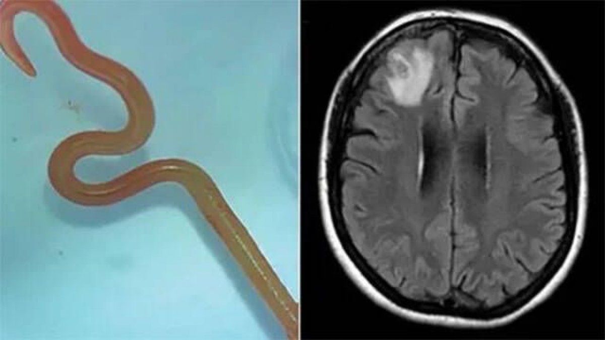 Ezkerrean, emakumeari atera zioten zizarea. Eskuinean, burmuinaren erradiografia. ANU