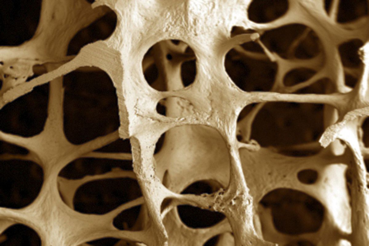 Osteoporosiak hezurrak haustea eragiten du. BERRIA.