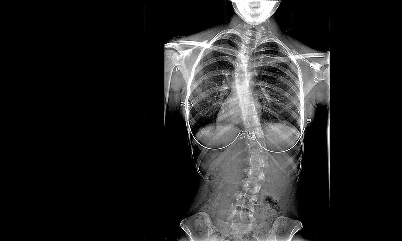 Eskoliosia 16 urteko neska baten erradiografian. UTAHKO UNIBERTSITATEKO OSPITALEA.