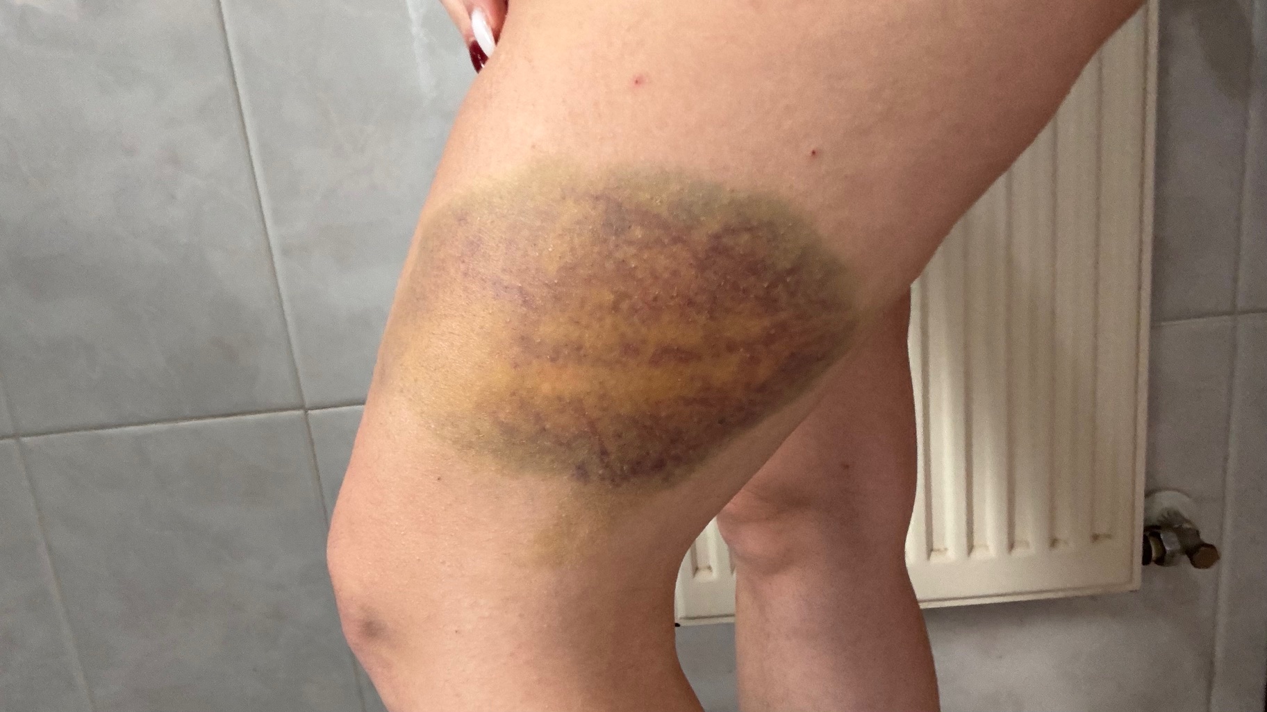 Ertzain batek A.O. gazteari hanketan eragindako zauri bat. BERRIA