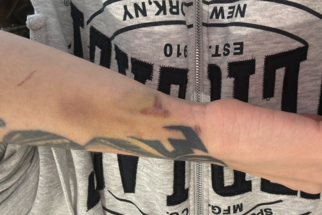 (ID_17658234548835) A. O. ertzainak eragindako zauriak. (ID_17658234548835) A. O. ertzainak eragindako zauriak.