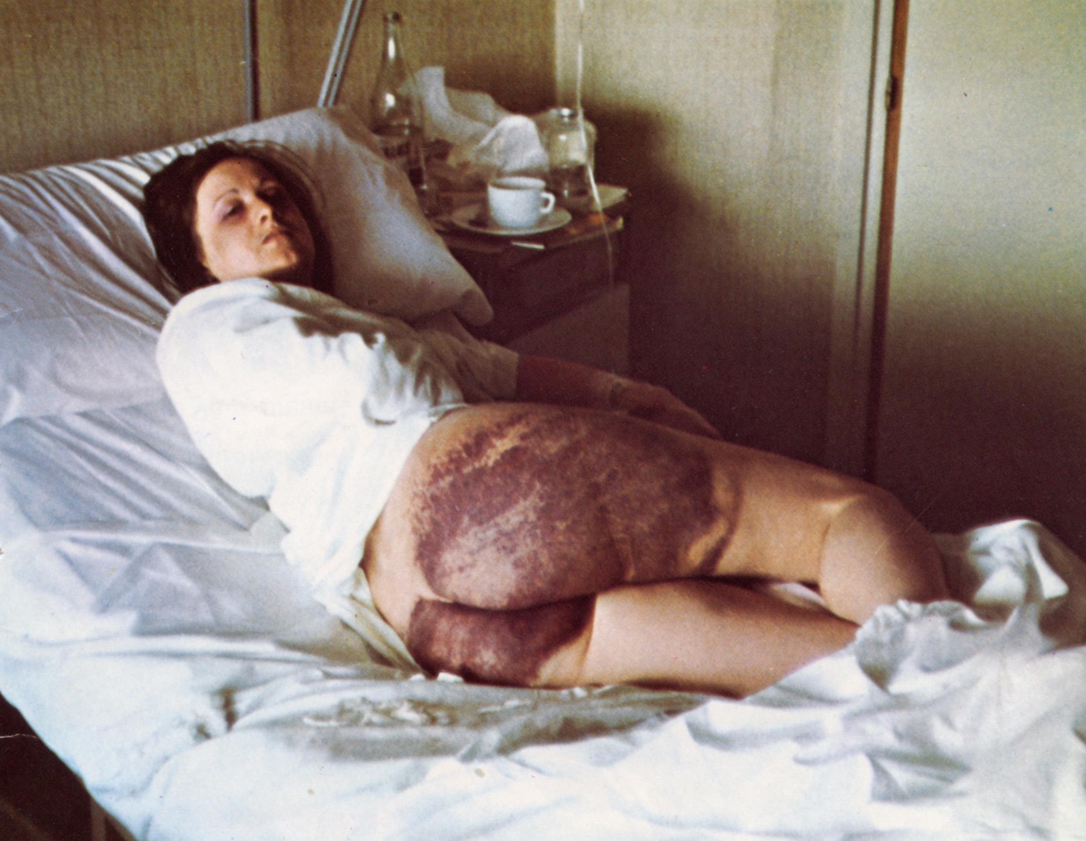 Anparo Arangoa, torturak jasan ostean, 1976an. JAVIER YABEN / ARGIA