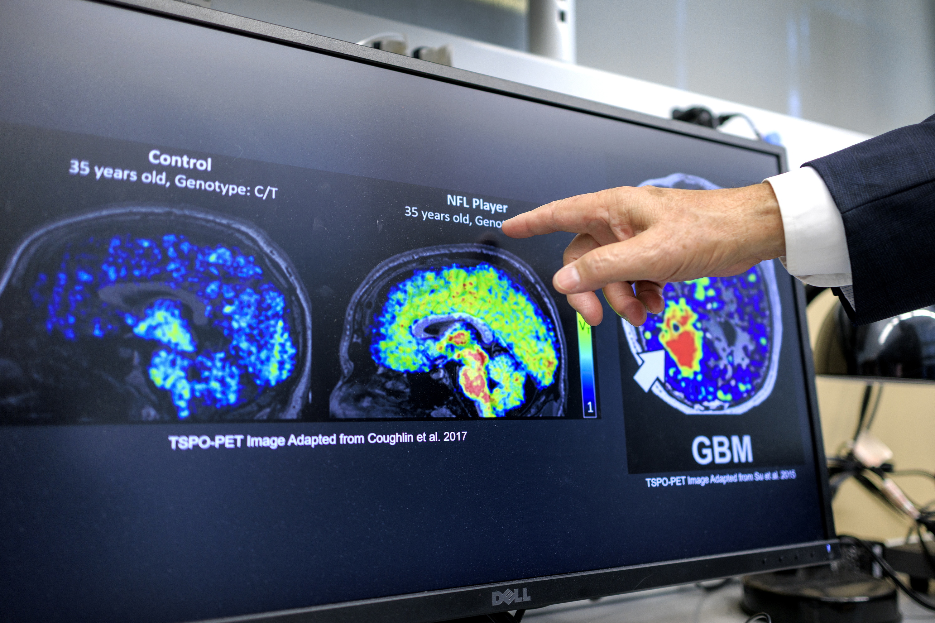 Alzheimerra diagnostikatzeko irudien azterketa, artxiboko irudi batean. CRISTOBAL HERRERA-ULASHKEVICH / EFE